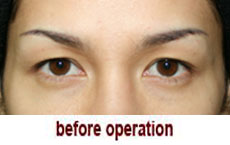 plastic-surgery-blepharoplasty